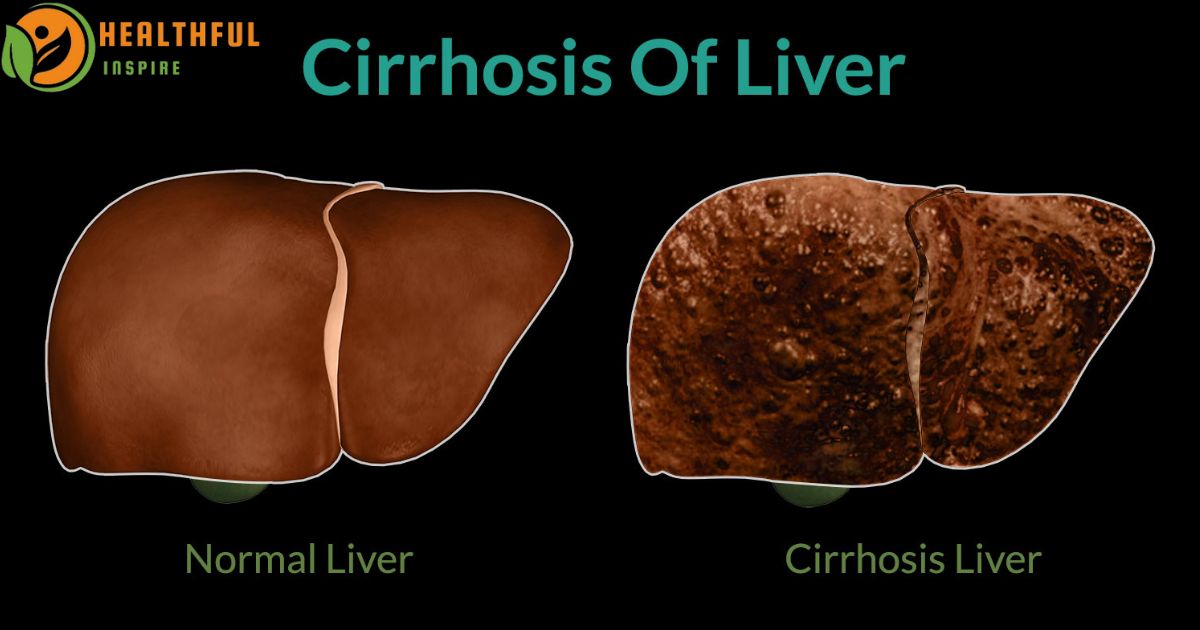 Can a Plant-Based Diet Reverse Cirrhosis of the Liver