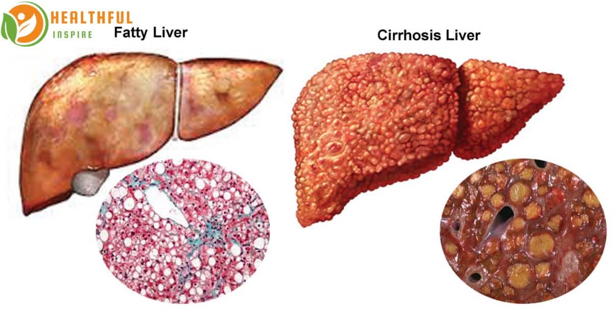 Understanding Cirrhosis of the Liver